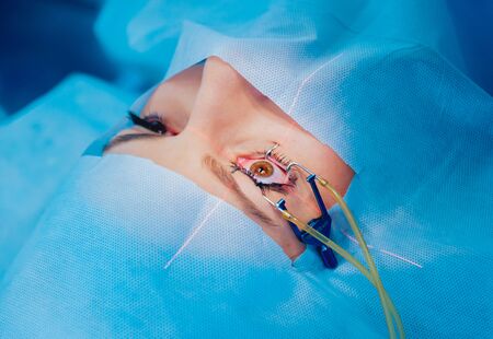 Laser vision correction. A patient and team of surgeons in the operating room during ophthalmic surgery. Eyelid speculum. Lasik treatment. Patient under sterile coverの写真素材