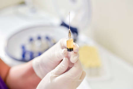 Platelet-Rich plasma preparation. Syringe with plasma in handsの写真素材