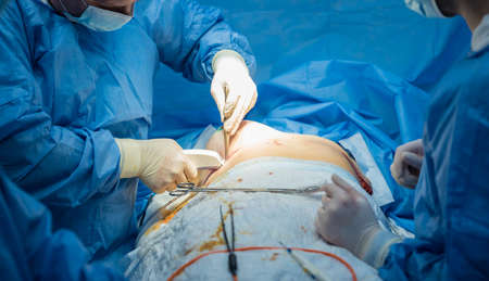 Breast augmentation under the guidance surgeons team in surgical operating room.の写真素材