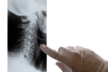 A doctor in white gloves points a finger at an x-ray of the cervical spine. Close-up. Copy space....