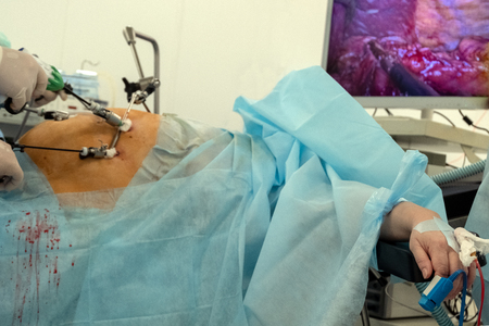 Doctors use endo-instruments and video cameras to perform surgery in the abdominal cavity of a fat woman. The procedure in the operating room of the hospital is translated online to a monitor or 4k TV. Endovideosurgery. Modern advances in medicine. Endoscopy.の写真素材