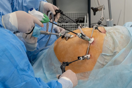 Laparoscopy. The hands of doctors using laparoscopic instruments perform surgery in the abdominal...