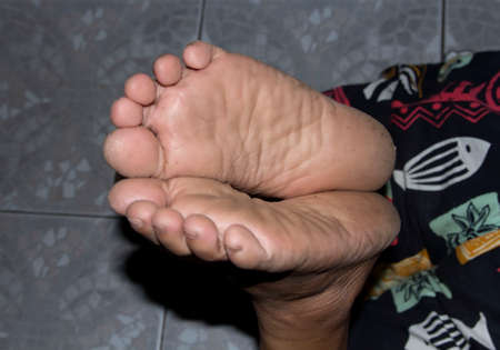 Close-up of a woman's feet with wrinkles and rough cracks due to hard work and winter painful woundsの写真素材