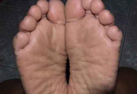 Close-up of a woman's feet with wrinkles and rough cracks due to hard work and winter painful woundsの写真素材