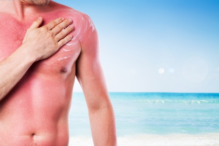 Man with a sunburn isolated on white backgroundの写真素材