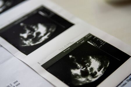 Image of Heart ultrasound with health danger printed on paper.の写真素材