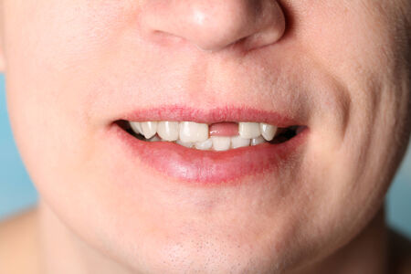 Smile of man without one front tooth