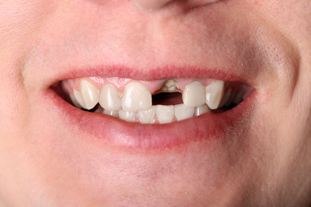 Smile of man without one front tooth