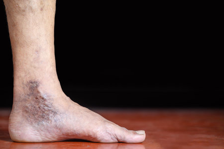Detailed image showing the effect of skin discoloration and varicose veins on a person's foot, highlighting the condition's impact and visual characteristics to aid educational, medical, and discussion purposes.の写真素材