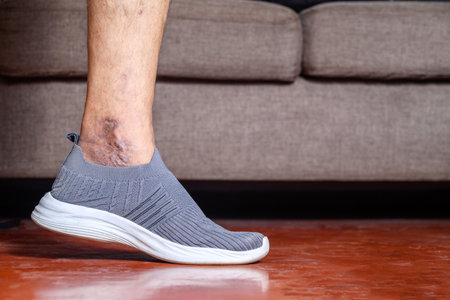 Detailed image showing the effect of skin discoloration and varicose veins on a person's foot, wearing a gray knitted slip-on shoe, placed on a wooden floor with a blurred sofa in the background, highlighting the condition's impact and visual characteristics to aid educational, medical, and discussion purposes.の写真素材