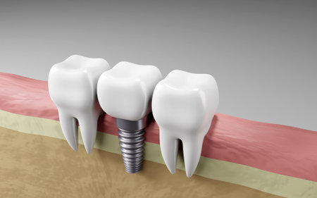 Dental teeth implants. Oral health and dental inspection teeth. Medical dentist tool, children healthcareの写真素材