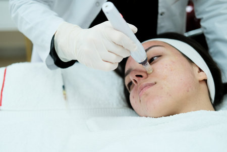 Closeup view of woman having microneedling procedure applied on her face