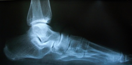 X-ray image of normal foot sideの写真素材