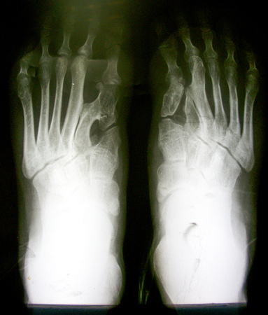 X-ray image of normal foot both sideの写真素材