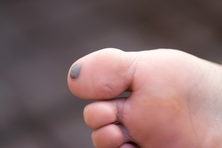 Bruise on big toe の写真素材