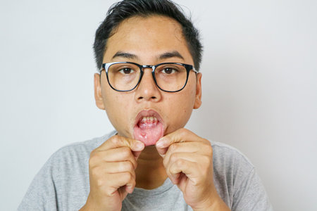 close up man's lip have a mouth ulcer. Stomatitis on the lip. Health problem concept.の写真素材