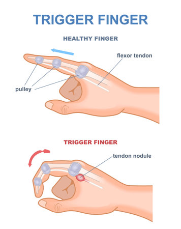 Trigger finger diagramの素材 [FY310205702191]