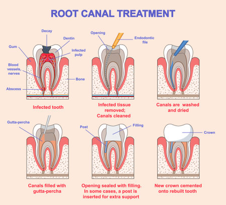 Root canal treatment. Medical infographic or diagram with stages of dental treatment. Diagnostics and filling of teeth damaged by caries. Flat vector illustrationのイラスト素材