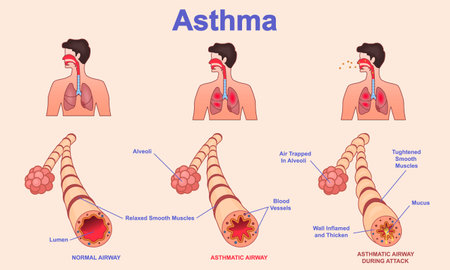 Anatomy of Asthma. Medical diagram showing stages of asthma attack with healthy and unhealthy bronchial tube. Breathing problems and respiratory muscle tightening. Cartoon flat vector illustrationのイラスト素材