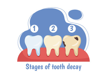Stages of tooth decay. Medical infographics and educational materials. Cleanliness and hygiene. Diagnosis and treatment. Flat vector illustrationのイラスト素材