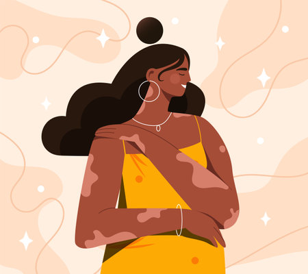 Woman with vitiligo. Young girl suffer from skin disease. African american person with white spots on skin. Diversity and tolerance. Self love and acceptance. Flat vector illustrationのイラスト素材