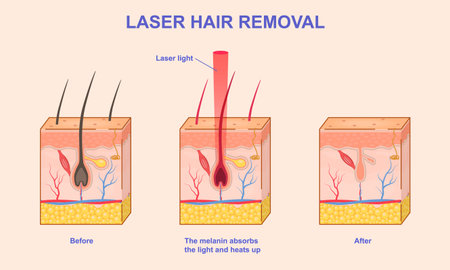 Laser hair removal. Infographics showing layers of skin and process of hair removal using laser beam. Cosmetology procedure. Isometric 3D vector illustration collectionのイラスト素材
