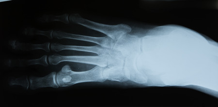 human foot ankel and leg xray pictureの写真素材