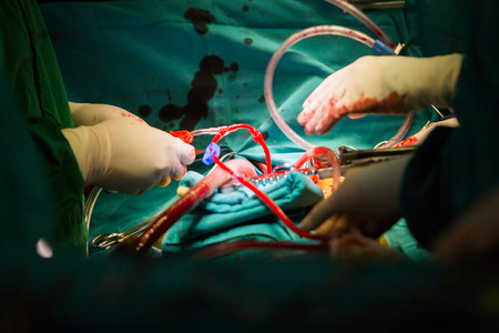 Surgery for Coronary Artery Bypass Grafting: CABGの写真素材