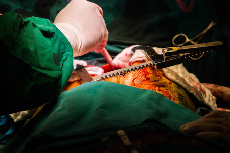 coronary artery bypass grafting