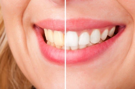 Before and after of a dental whitening procedureの写真素材