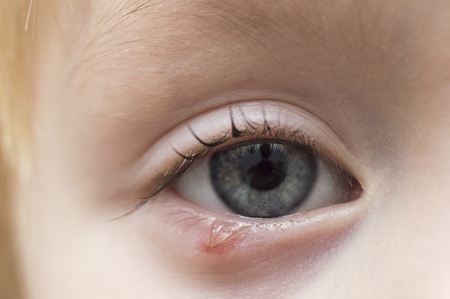Illness person eye with sty and pus looking into the cameraの写真素材