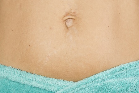 female abdomen with insignificant stretch marks on the skin, close-upの写真素材