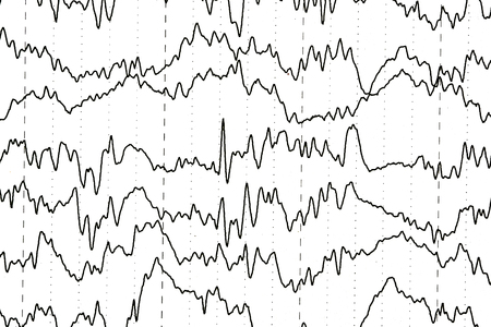 Brain wave patterns on electroencephalogram, EEG of the pediatric patients, problems in the electrical activity of the brain.の写真素材