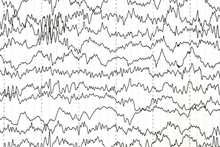 Brain wave patterns on electroencephalogram, EEG of the pediatric patients, problems in the electrical activity of the brain.の写真素材