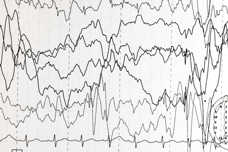Abnormal brain wave in human EEG of the patients problems in the electrical activity of the brain.Abnormal EEG.の写真素材