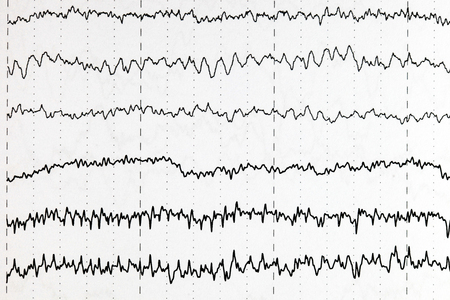 Abnormal brain wave in human EEG of the patients problems in the electrical activity of the brain.Abnormal EEG.の写真素材