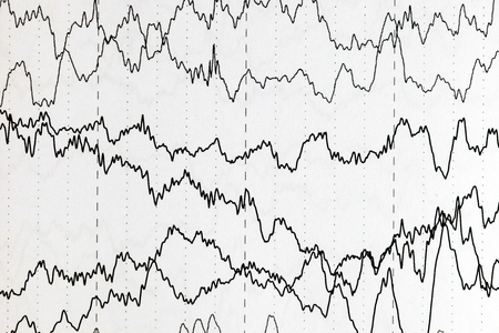 Abnormal brain wave in human EEG of the patients problems in the electrical activity of the brain.Abnormal EEG.の写真素材