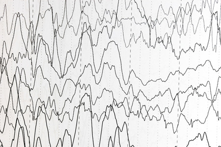 Abnormal brain wave in human EEG of the patients problems in the electrical activity of the brain.Abnormal EEG.の写真素材