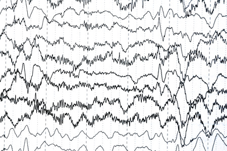 Abnormal brain wave in human EEG of the patients problems in the electrical activity of the brain.Abnormal EEG.の写真素材