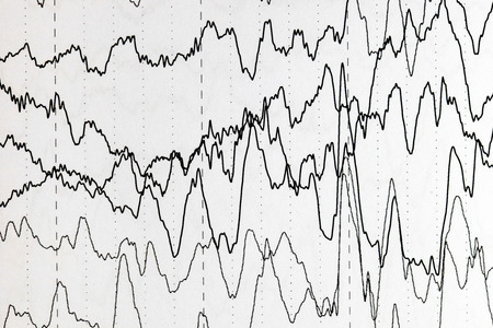 Abnormal brain wave in human EEG of the patients problems in the electrical activity of the brain.Abnormal EEG.の写真素材