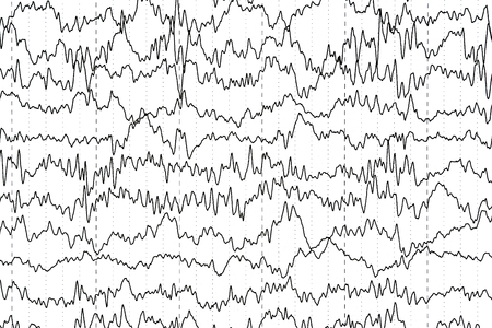 Abnormal brain wave in human EEG of the patients problems in the electrical activity of the brain.Abnormal EEG.の写真素材