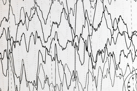 Abnormal brain wave in human EEG of the patients problems in the electrical activity of the brain.Abnormal EEG.の写真素材