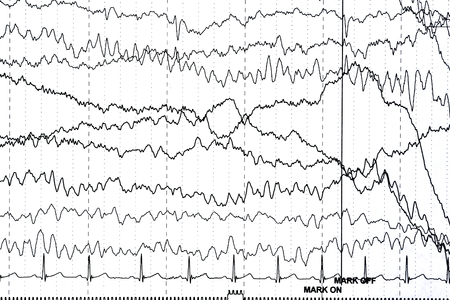 Abnormal brain wave in human EEG of the patients problems in the electrical activity of the brain.Abnormal EEG.の写真素材