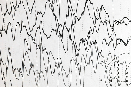 Abnormal brain wave in human EEG of the patients problems in the electrical activity of the brain.Abnormal EEG.の写真素材