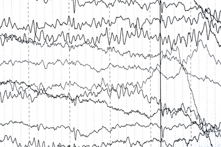 Abnormal brain wave in human EEG of the patients problems in the electrical activity of the brain.Abnormal EEG.の写真素材