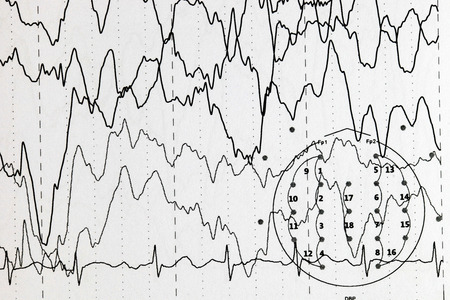 Abnormal brain wave in human EEG of the patients problems in the electrical activity of the brain.Abnormal EEG.の写真素材