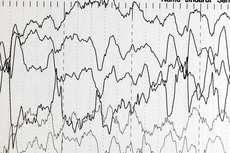 Abnormal brain wave in human EEG of the patients problems in the electrical activity of the brain.Abnormal EEG.の写真素材