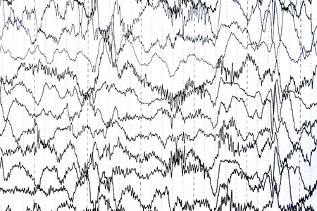 Abnormal brain wave in human EEG of the patients problems in the electrical activity of the brain.Abnormal EEG.の写真素材