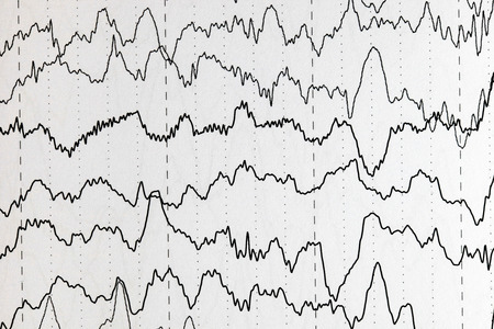 Abnormal brain wave in human EEG of the patients problems in the electrical activity of the brain.Abnormal EEG.の写真素材