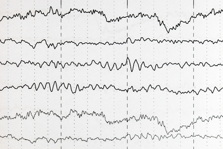 Abnormal brain wave in human EEG of the patients problems in the electrical activity of the brain.Abnormal EEG.の写真素材